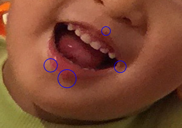 ヘルペス性口内炎 子どもが39度の高熱 舌や歯茎の口内炎で食べない よしぱんblog